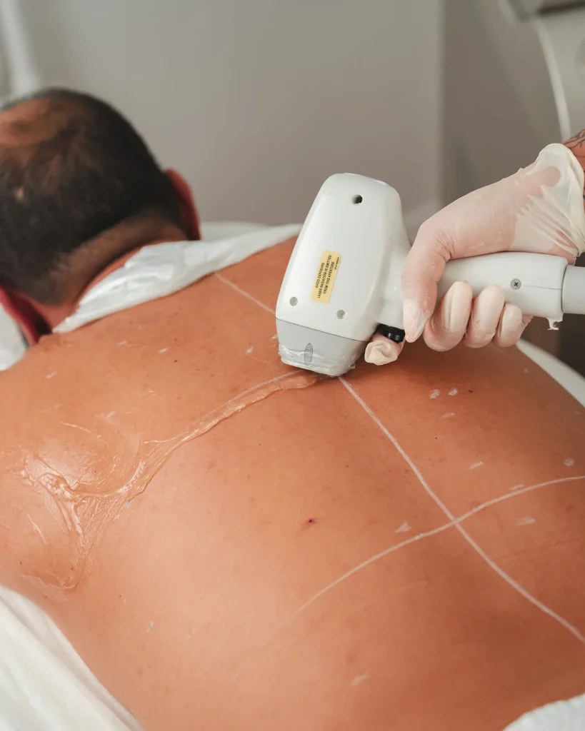 Triệt lông là gì: cơ chế laser IPL và điều cần biết