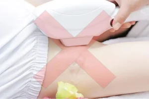 Bác sĩ không khuyến cáo Laser và IPL khi mang thai vì thiếu dữ liệu an toàn và nhiệt dễ gây tổn thương da.
