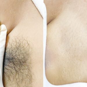 Mỗi buổi chỉ từ 30–90 phút và cần đủ liệu trình 10–12 buổi để giảm tới 75% lông lâu dài, lông mọc lại mảnh và nhạt màu hơn.