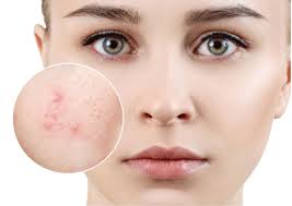 Không nên triệt lông mặt khi da đang bị mụn viêm để tránh làm vỡ mụn, lây lan vi khuẩn và khiến tình trạng kích ứng nghiêm trọng hơn.