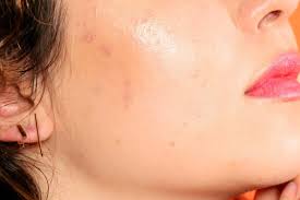 Da mụn có nên triệt lông mặt? Lời khuyên từ bác sĩ da liễu
