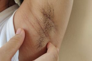Do hormone estrogen tăng cao thúc đẩy lông nách mọc nhanh và nhiều, nhưng sẽ tự ổn định lại sau sinh 6 tháng.