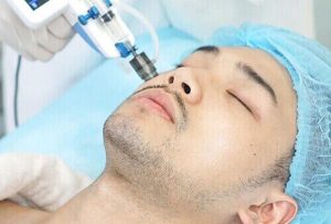 Triệt laser râu quai nón giúp sạch lông lâu dài, ngừa viêm nang lông và thâm sạm.