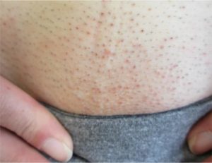 Quy trình triệt lông không đảm bảo vệ sinh hoặc dùng hóa chất mạnh dễ khiến vùng bikini bị viêm đỏ và ngứa rát kéo dài.