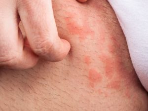 Kiêng quan hệ sau triệt lông giúp hạn chế ma sát gây tổn thương, sưng rát và viêm nang lông vùng kín.