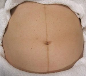 Di truyền đa gen quyết định mật độ, màu sắc và mức độ rậm của lông bụng, là đặc điểm sinh lý tự nhiên thừa hưởng từ gia đình.