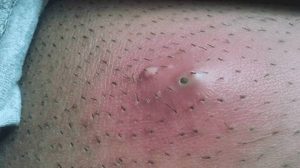 Lông bikini mọc ngược xảy ra khi sợi lông xoăn dày cuộn ngược vào trong da, gây viêm sưng, ngứa rát hoặc hình thành mụn mủ sau khi dọn lông.