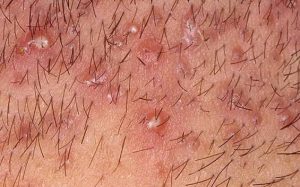 Lông mọc ngược không quá nguy hiểm nhưng nếu không xử lý đúng cách có thể dẫn đến nhiễm trùng, thâm sạm và để lại sẹo vĩnh viễn.