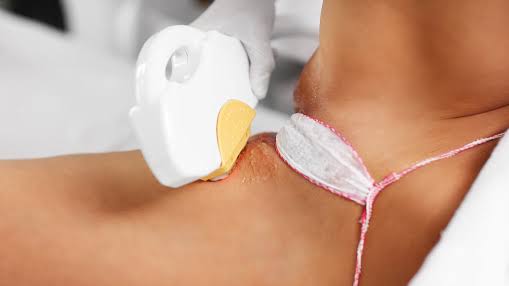 Công nghệ Diode Laser cần giãn cách mỗi buổi triệt lông từ 4–8 tuần để nang lông bước vào chu kỳ mới và da hồi phục hoàn toàn, mang lại hiệu quả bền vững lâu dài.
