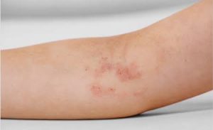 Tinh dầu trầu không nồng độ cao kết hợp nhiệt độ nóng dễ gây kích ứng, đỏ rát và bỏng da nghiêm trọng do viêm da tiếp xúc.