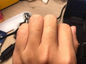 Triệt lông ngón tay: 6 cách an toàn và hiệu quả