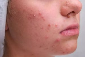 Nhiệt lượng từ laser gây kích ứng nang lông xung quanh, xuất hiện nốt đỏ như mụn rát nhẹ nhưng thường tự biến mất sau 1–3 ngày.