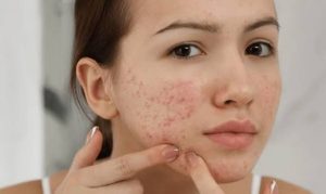 Tác động nhiệt từ laser hoặc lực cơ học làm suy yếu hàng rào biểu bì, khiến nang lông giãn nở và dễ bị vi khuẩn xâm nhập gây viêm.