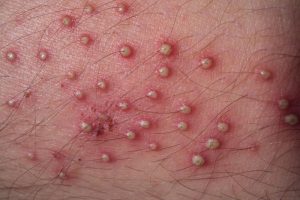 Nếu bị viêm nang lông sau triệt lông với các nốt mụn đỏ sưng mủ, bạn cần thăm khám bác sĩ sớm để được kê đơn điều trị kịp thời.