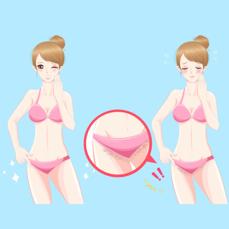 Quy trình triệt lông bikini chuẩn: 7 bước an toàn, không đau
