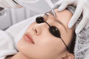 Laser cần 8–10 buổi (cách nhau 4 tuần) để giảm 70–80% lượng lông, do tia chỉ tác động vào nang lông đang ở chu kỳ phát triển.