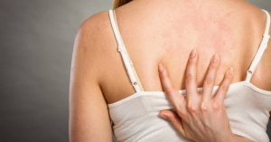 Xoáy lông ở lưng là biến thể lành tính, khi nang lông mọc vòng xoắn tự nhiên tương tự như xoáy tóc.